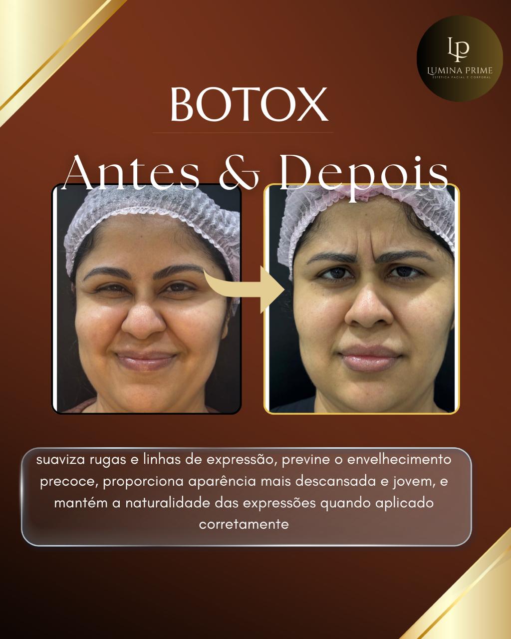 Aplicação de Botox em São Bernardo do Campo