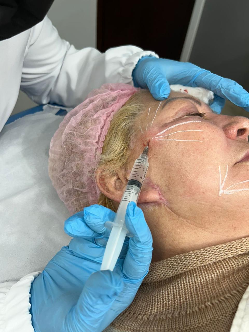 Botox masculino São Bernardo do Campo