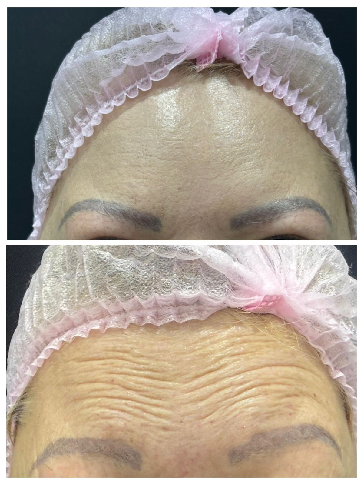 Antes e depois Botox Full Face — Lumina Prime SBC