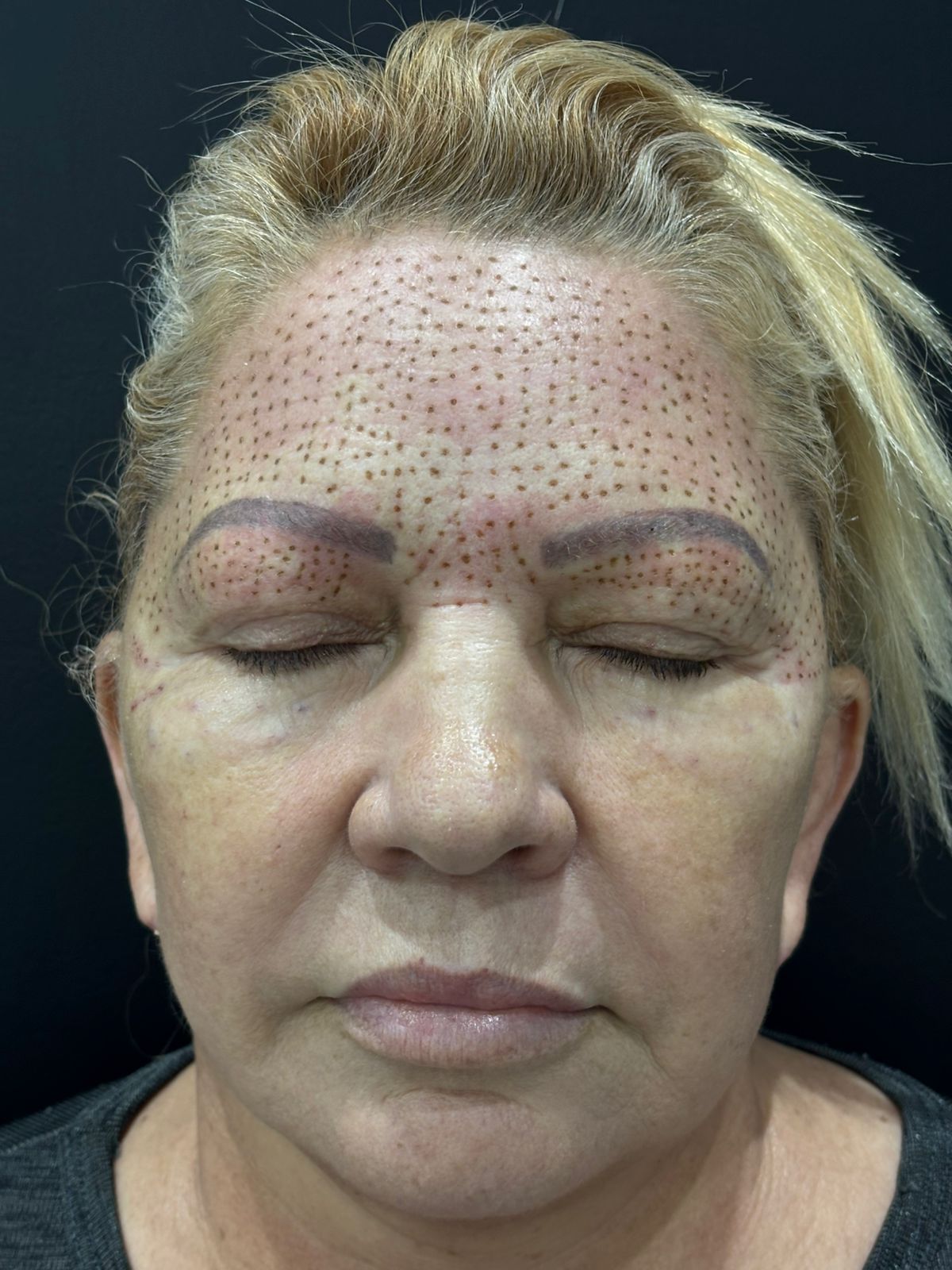 Jato de Plasma em São Bernardo do Campo — blefaroplastia sem corte, rejuvenescimento — Dra. Mislene Barros