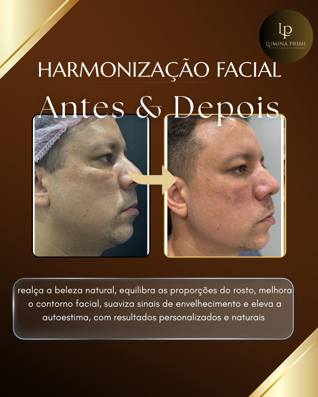 Harmonização Facial Masculina em São Bernardo do Campo — antes e depois natural — Dra. Mislene Barros