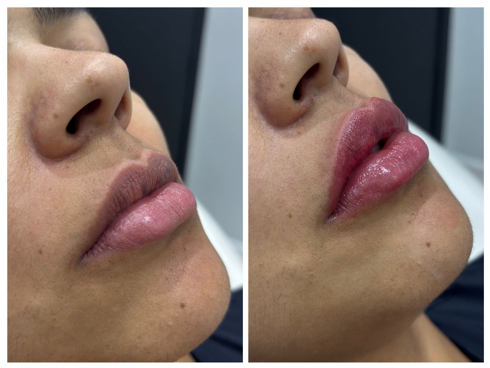 Antes e depois Preenchimento Labial — Lumina Prime SBC